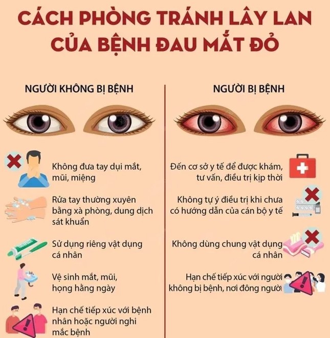 700 trẻ đau mắt đỏ nhập viện trong một tháng - Ảnh 1.