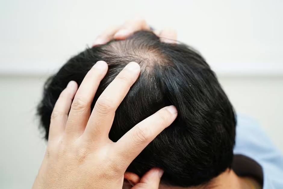 Rụng lông, tóc ở 3 vùng trên cơ thể có thể là dấu hiệu cảnh báo bạn đang mắc bệnh này- Ảnh 2.