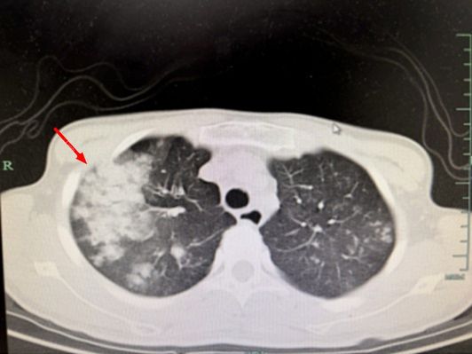 Thanh niên 20 tuổi sốt cao, đi khám phát hiện phổi trắng xóa: Tác nhân gây bệnh quen thuộc đến bất ngờ - Ảnh 3.
