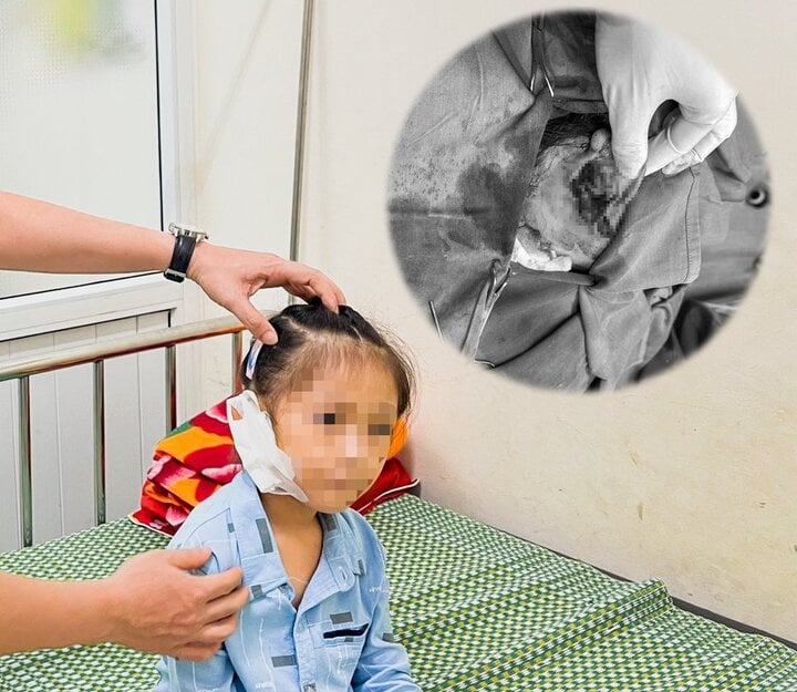 Bé gái 6 tuổi đứt tai vì kính vỡ trong lúc chơi đùa ở nhà - Ảnh 1.