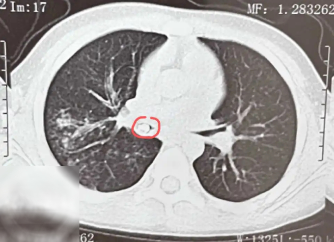 Cậu bé liên tục ho sốt, bác sĩ chụp CT phổi thấy thứ không ai ngờ tới - Ảnh 2.