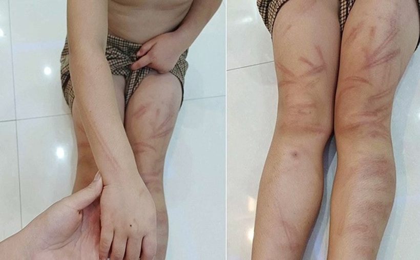 Tình hình sức khỏe mới nhất của 6 trẻ mầm non bị đánh bầm tím ở Nghệ An - Ảnh 1. Tình hình sức khỏe mới nhất của 6 trẻ mầm non bị đánh bầm tím ở Nghệ An - Ảnh 1.