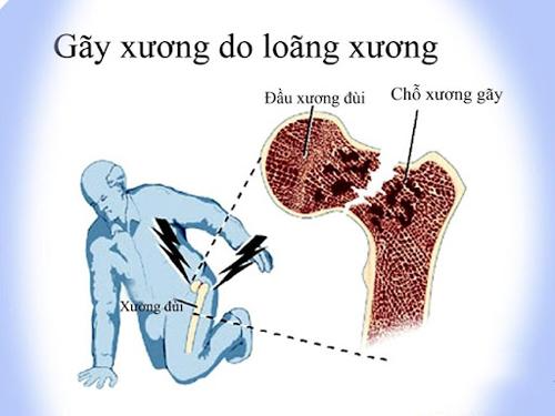 Bật mí bí quyết chắc khỏe xương cho cả nhà - Ảnh 2.