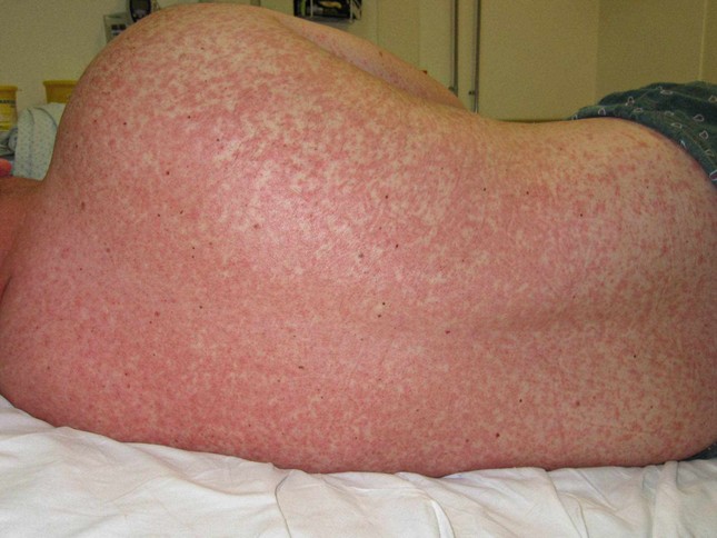 vwh-dermnetnz-measles-01-8e2f8083378f459189545803d3168a94-9524-1730120363844-1730120363920606671174.jpg