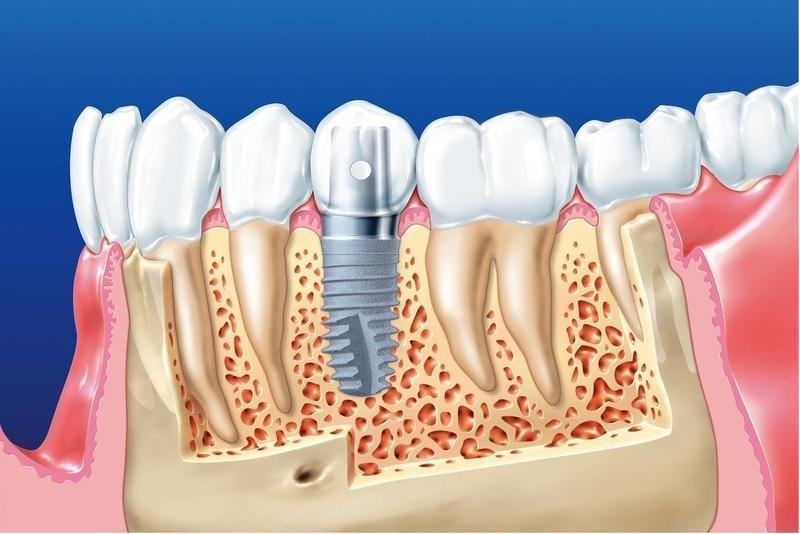 3 điều quan trọng cần biết trước khi trồng răng implant- Ảnh 1.