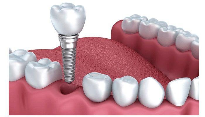 3 điều quan trọng cần biết trước khi trồng răng implant- Ảnh 2.