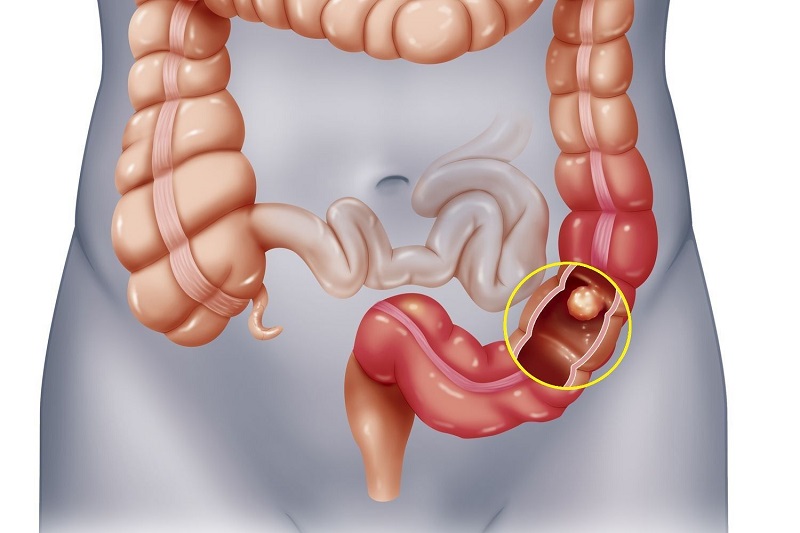 Bị ung thư ruột ở tuổi 24, cô gái khuyên mọi người đừng bỏ qua 1 việc quan trọng giúp cứu sống mình- Ảnh 3.