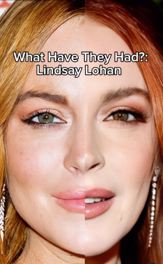 lindsay-lohan-su-dung-sculptra-de-cai-lao-hoan-dong4-17326940707712003302600.png