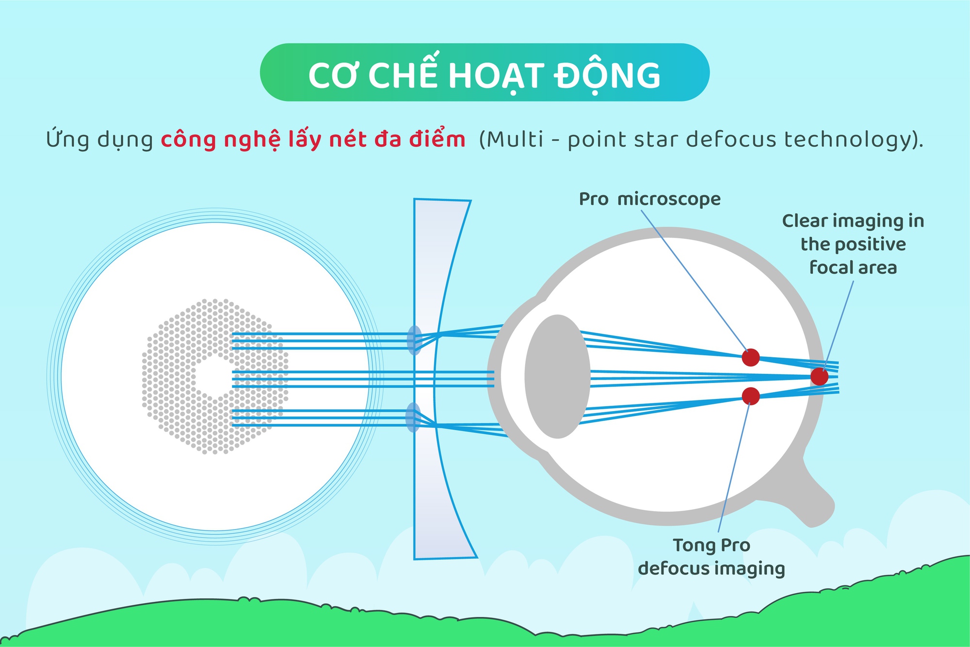 co-che-hoat-dong-trong-kinh-defocus-smart-lens-visual-tech-trong-kinh-han-che-can-thi-17310641899051911529739-1731069734407-17310697345081095563253.jpg