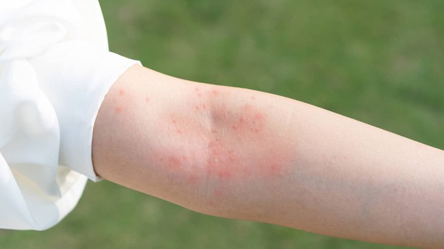 eczema-closeup-3367-1731047854242-173104785448264151667.jpg