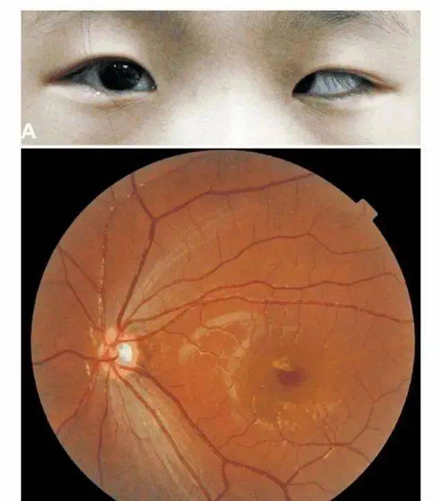 X&oacute;t xa đ&ocirc;i mắt của em b&eacute; 5 tuổi nghiện game tr&ecirc;n điện thoại - Ảnh 1.