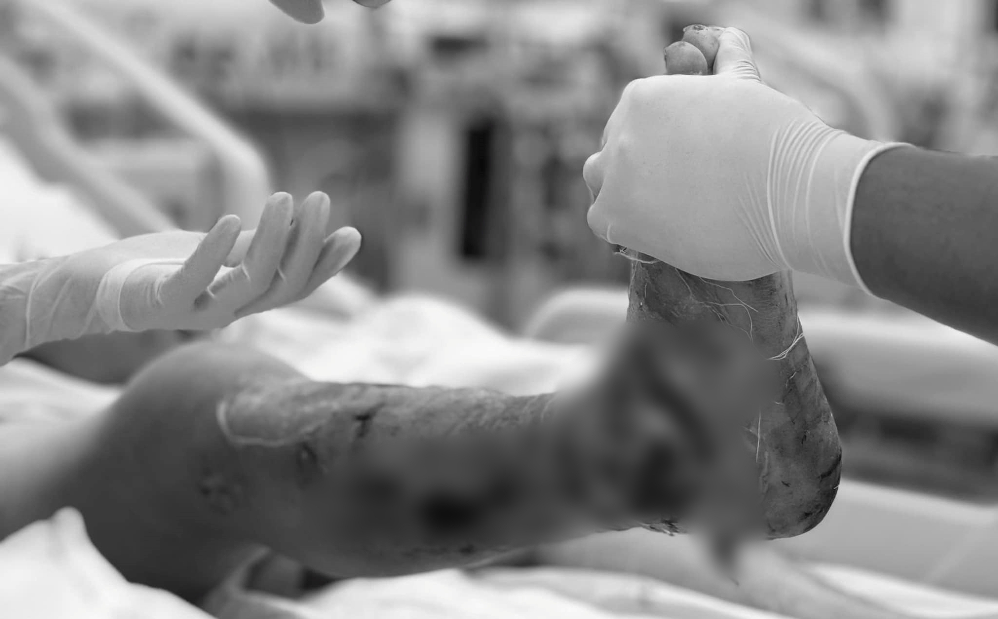 Người đàn ông suy kiệt toàn thân, sốc nhiễm khuẩn vì tự chữa khối u cổ chân tại nhà- Ảnh 2. Người đàn ông suy kiệt toàn thân, sốc nhiễm khuẩn vì tự chữa khối u cổ chân tại nhà- Ảnh 2.