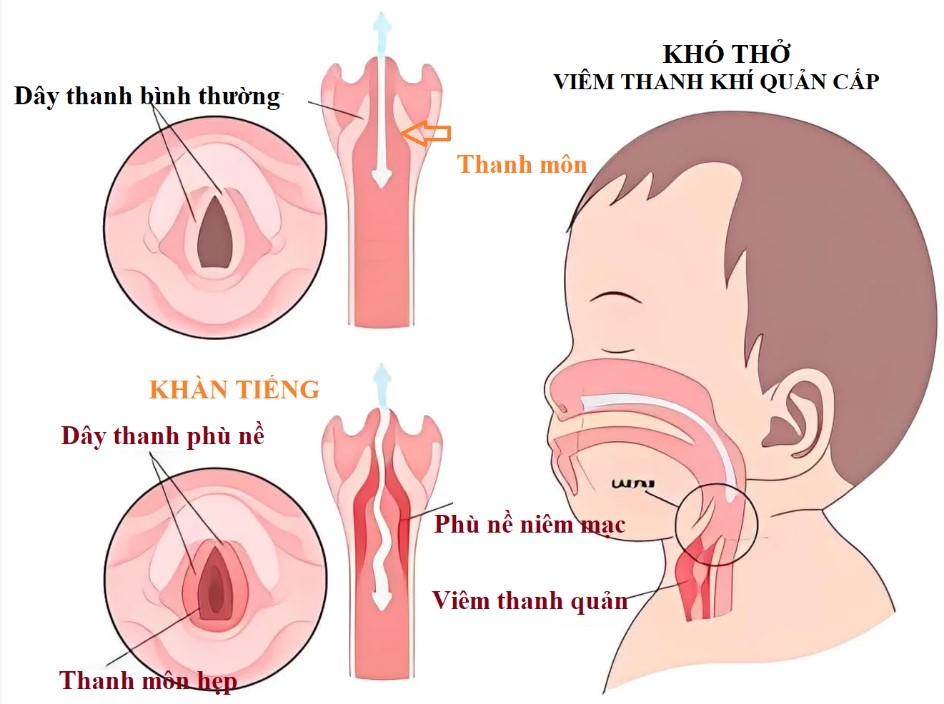 Viêm thanh quản ở trẻ em trong mùa lạnh: Nhận diện, điều trị và phòng bệnh - Ảnh 1.