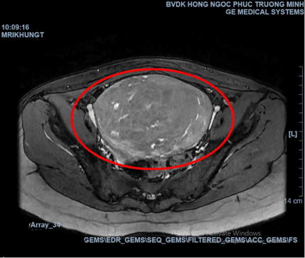 Vượt ngàn km về Việt Nam để mổ u xơ tử cung khổng lồ - Ảnh 2.