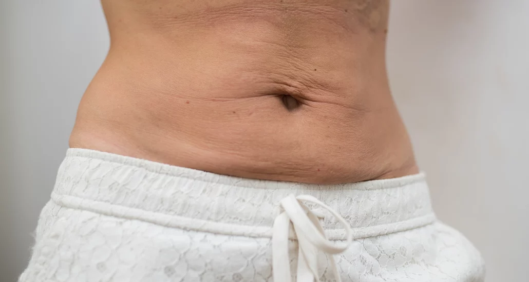 loose-stomach-skin-1708569117228979603668-1708661165866-17086611664151122159258.png
