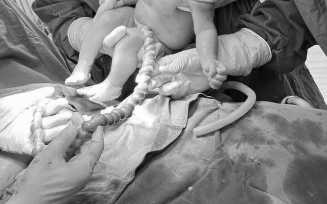 Sản phụ 20 tuổi chuyển dạ, bác sĩ siêu âm giật mình trước hình ảnh bất thường của dây rốn: Mổ lấy thai khẩn cấp! - Ảnh 1.