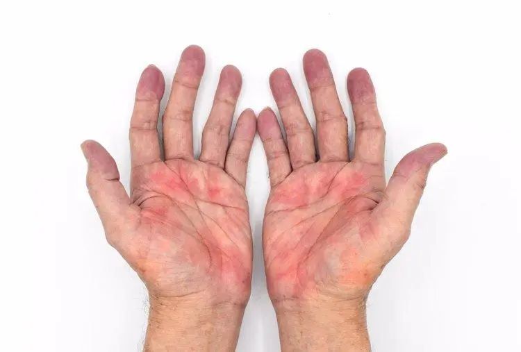 Bác sĩ ung bướu tiết lộ &quot;điềm báo&quot; ung thư lộ rõ trên bàn tay: Nếu có 3 điểm bất thường nên đi khám khẩn cấp - Ảnh 2.