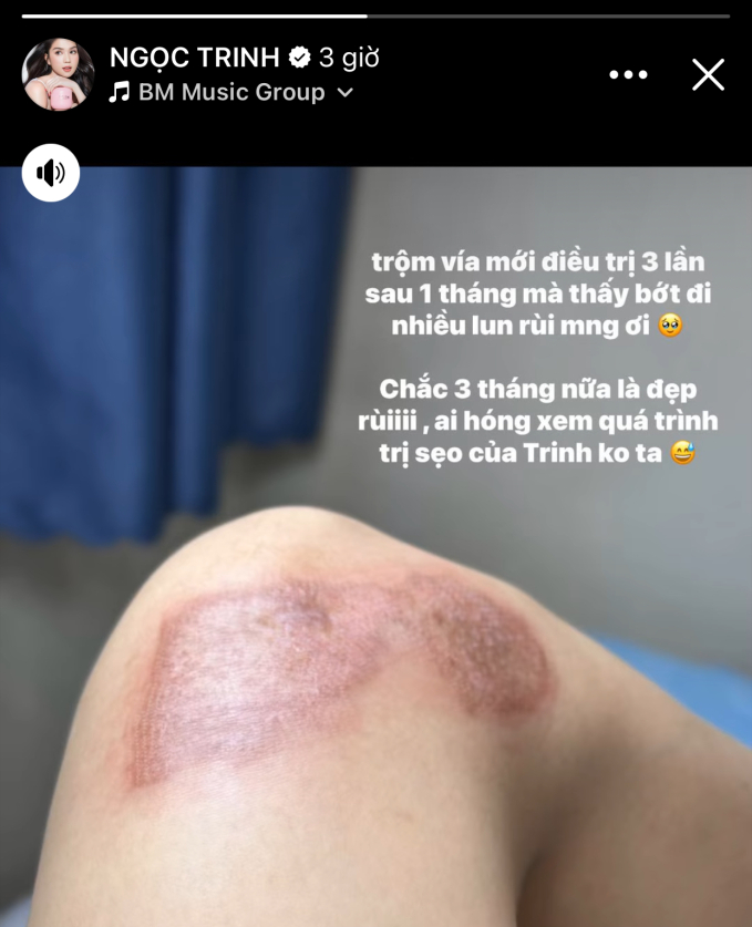 Sau 1 tháng điều trị, Ngọc Trinh tiết lộ hình ảnh vết thương do tai nạn khi &quot;diễn xiếc&quot; trên mô tô để lại- Ảnh 1.