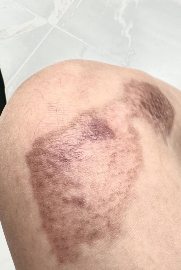 Sau 1 tháng điều trị, Ngọc Trinh tiết lộ hình ảnh vết thương do tai nạn khi &quot;diễn xiếc&quot; trên mô tô để lại- Ảnh 2.