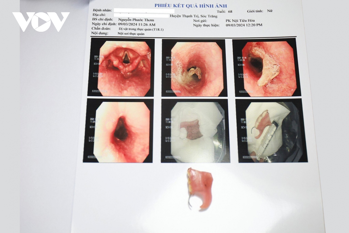 Lấy thành công hàm răng giả trong thực quản cụ bà 68 tuổi - Ảnh 1.