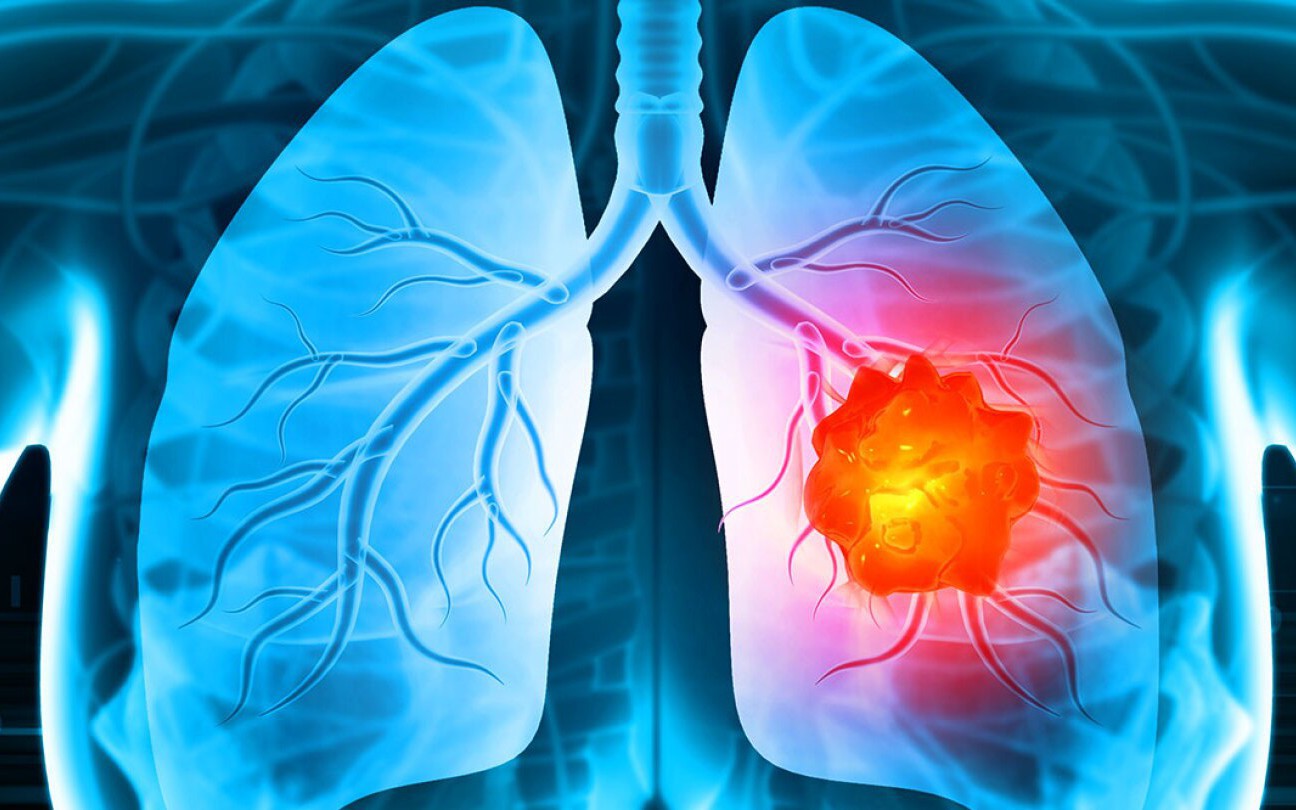 Không bao giờ hút thuốc vẫn có thể bị ung thư phổi: Đây là 11 dấu hiệu cảnh báo nguy hiểm