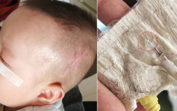 Y tá ‘quên’ ống luồn kim trong đầu em bé, 5 năm sau nó trôi xuống cổ