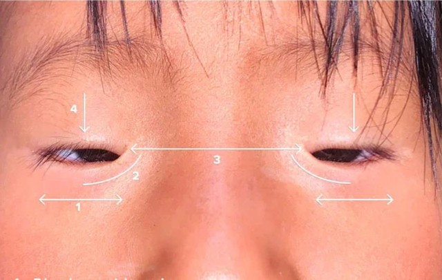 Đột biến di truyền “Đôi mắt u buồn” khiến 6 phụ nữ cùng dòng họ vô sinh - Ảnh 2. Đột biến di truyền “Đôi mắt u buồn” khiến 6 phụ nữ cùng dòng họ vô sinh - Ảnh 2.