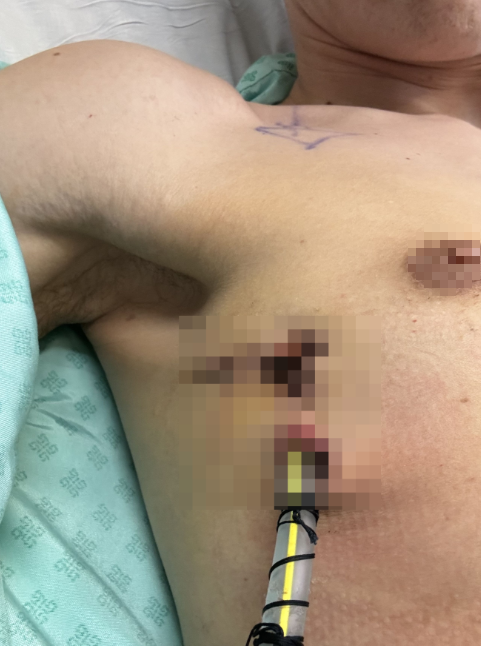 Thanh niên 29 tuổi đang khỏe bỗng ngã quỵ, ngực đau như bị đâm: Bác sĩ nói do 1 thói quen cực có hại - Ảnh 4.