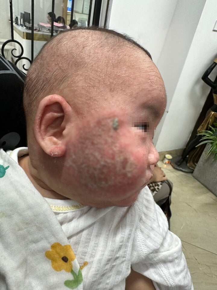 Được tắm nước lá trị viêm da cơ địa, bé 5 tháng tuổi loét mặt - Ảnh 1.