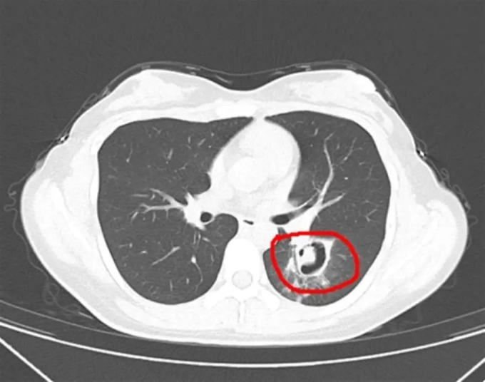 Dọn dẹp tủ quần áo, cô gái 24 tuổi mắc viêm phổi, bác sĩ nhắc một việc cần làm - Ảnh 1.