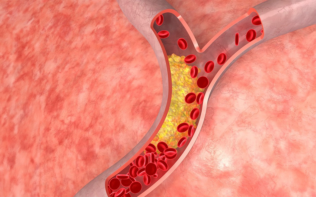 Không chỉ tim, mỡ máu cao còn gây ảnh hưởng tới 1 bộ phận khác cực quan trọng: BS cảnh báo