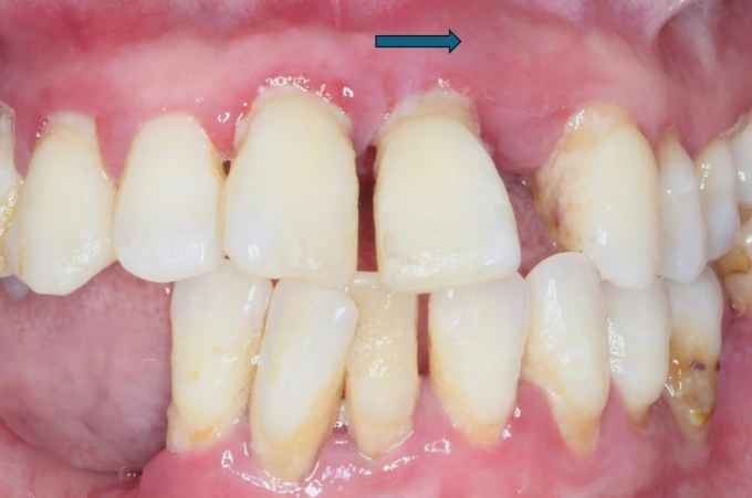 Bác sĩ cảnh báo thói quen nhiều người cứ ăn xong là làm, khiến răng càng ngày càng thưa, thậm chí làm teo nướu - Ảnh 2.