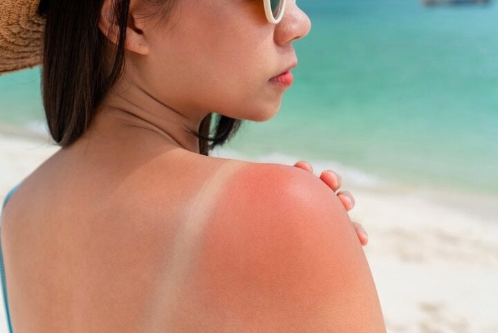 Lưu &yacute; để tr&aacute;nh da ch&aacute;y nắng, sạm đen khi đi biển - Ảnh 2.