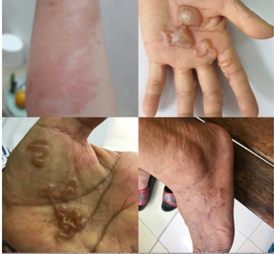 Nhiều trường hợp nhiễm bệnh