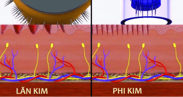 Tìm hiểu xu hướng làm đẹp bằng công nghệ phi kim sinh học (bio-microneedling) không xâm lấn - Ảnh 1.