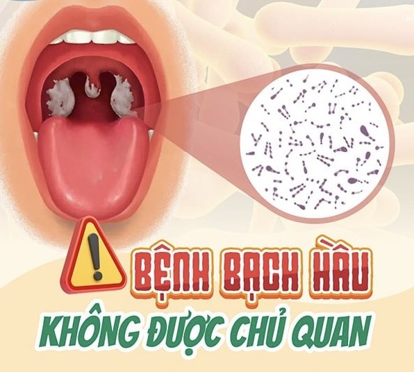 Bạch hầu là bệnh gì, vì sao có thể tử vong trong vài ngày? - Ảnh 1.