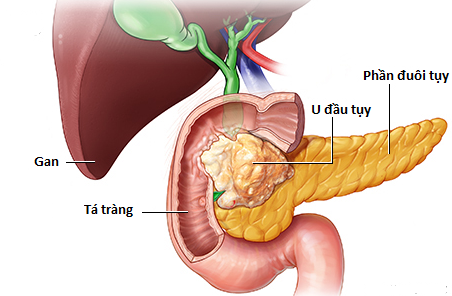 Chàng trai 29 tuổi bị đau lưng, BS nói chỉ còn sống được nửa năm, nguyên nhân do căn bệnh ung thư &quot;giỏi ngụy trang&quot; - Ảnh 4.