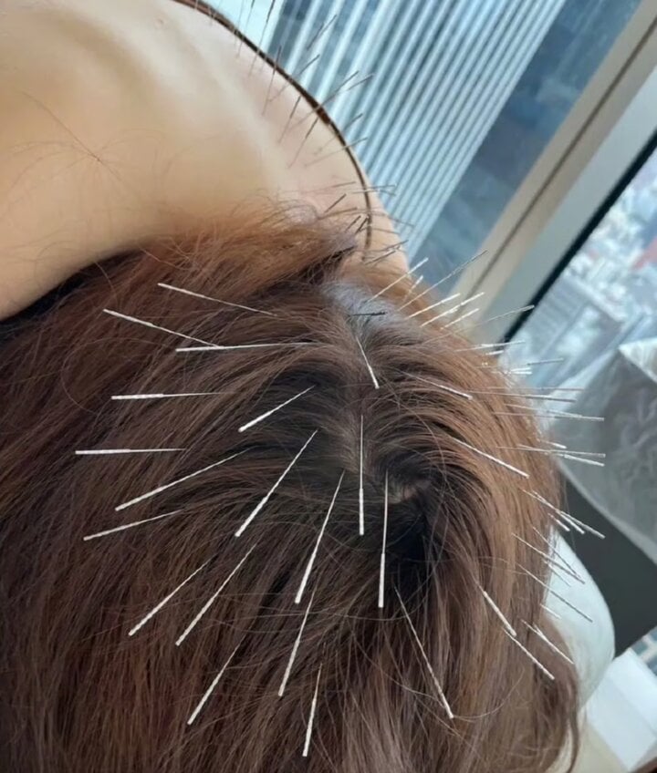 Rộ mốt ch&acirc;m kim đầy đầu để 'giết chết suy nghĩ', 30 ph&uacute;t tốn 34 triệu đồng - Ảnh 3.