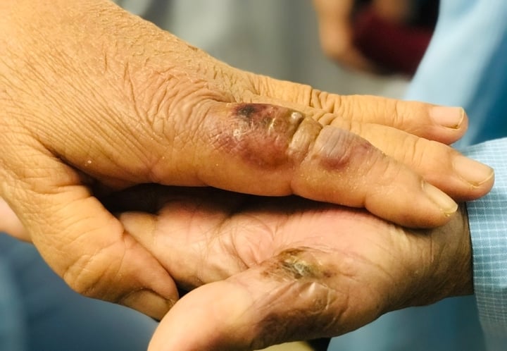 Bị chuột cắn vào tay, hai vợ chồng nhập viện - Ảnh 1. Bị chuột cắn vào tay, hai vợ chồng nhập viện - Ảnh 1.