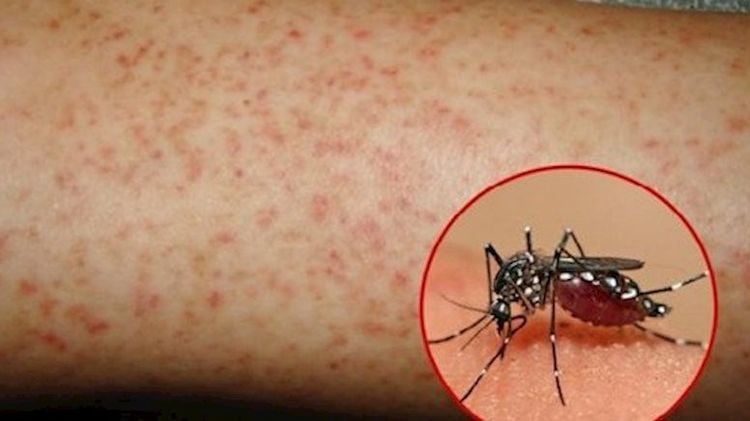 Mưa bão và ngập úng tăng nguy cơ bùng phát dịch sốt xuất huyết: Mẹ tuyệt đối không tự ý hạ sốt cho con bằng cách này!- Ảnh 4. Mưa bão và ngập úng tăng nguy cơ bùng phát dịch sốt xuất huyết: Mẹ tuyệt đối không tự ý hạ sốt cho con bằng cách này!- Ảnh 4.