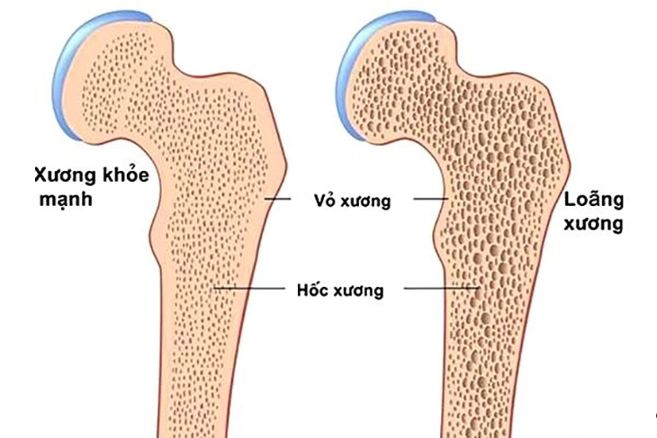 Tại sao phụ nữ hay bị loãng xương: BS giải thích vì phải rút canxi từ xương để làm việc này, quên bổ sung lại thì hậu quả càng rõ- Ảnh 2. Tại sao phụ nữ hay bị loãng xương: BS giải thích vì phải rút canxi từ xương để làm việc này, quên bổ sung lại thì hậu quả càng rõ- Ảnh 2.