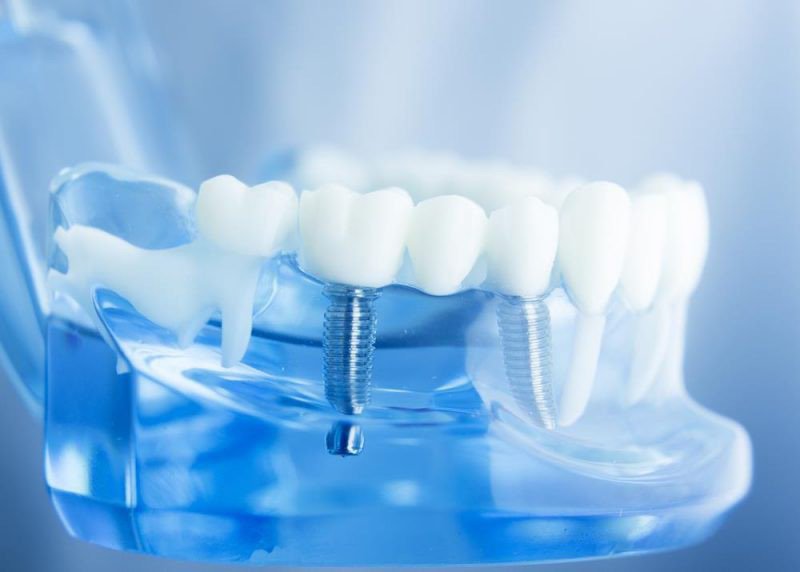 Trồng răng Implant: Đầu tư một lần, hiệu quả trọn đời, nâng cao chất lượng cuộc sống- Ảnh 2.