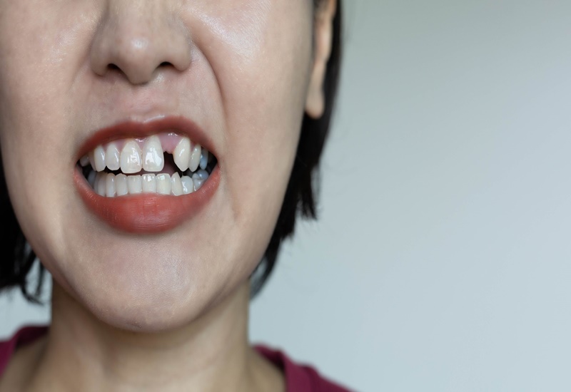 Trồng răng Implant: Đầu tư một lần, hiệu quả trọn đời, nâng cao chất lượng cuộc sống- Ảnh 1.
