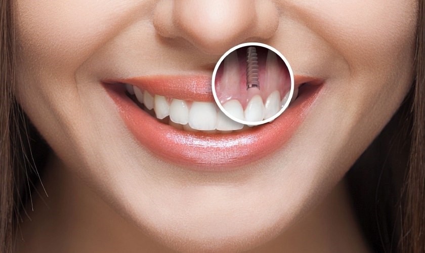 Trồng răng Implant: Đầu tư một lần, hiệu quả trọn đời, nâng cao chất lượng cuộc sống- Ảnh 3.