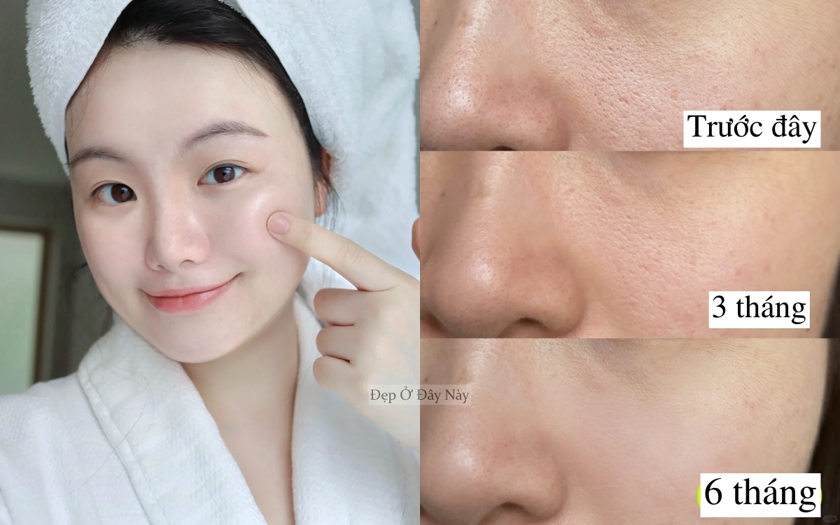 Từ làn da sần sùi, lỗ chân lông to tới mịn mướt như gương nhờ 6 tháng dưỡng da kiên trì - Ảnh 1. Từ làn da sần sùi, lỗ chân lông to tới mịn mướt như gương nhờ 6 tháng dưỡng da kiên trì - Ảnh 1.
