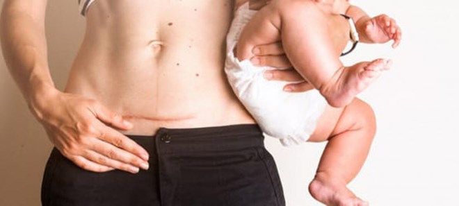 Sản phụ sinh mổ có nguy cơ đau đớn và rối loạn giấc ngủ cao hơn sản phụ sinh thường- Ảnh 2. Sản phụ sinh mổ có nguy cơ đau đớn và rối loạn giấc ngủ cao hơn sản phụ sinh thường- Ảnh 2.