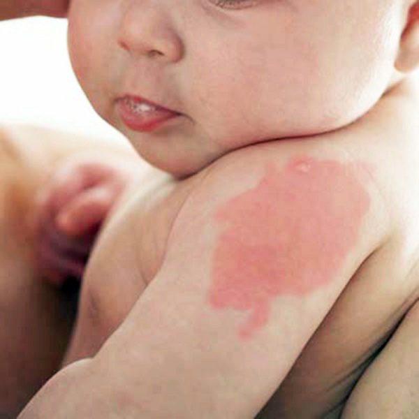 Em bé có bớt đỏ trên người: Dấu hiệu cho thấy con sinh ra với một “vết son” đặc biệt - Ảnh 2. Em bé có bớt đỏ trên người: Dấu hiệu cho thấy con sinh ra với một “vết son” đặc biệt - Ảnh 2.