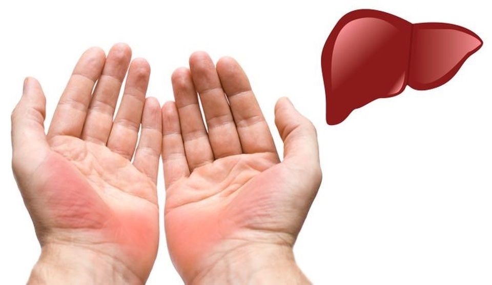 1 bộ phận cơ thể có mùi hôi là dấu hiệu nguy cơ ung thư gan, nhiều người không biết lại cứ giấu- Ảnh 3. 1 bộ phận cơ thể có mùi hôi là dấu hiệu nguy cơ ung thư gan, nhiều người không biết lại cứ giấu- Ảnh 3.