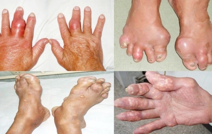 bien-chung-benh-gout-08345786-1760860652077-1760860657383892888162.jpg