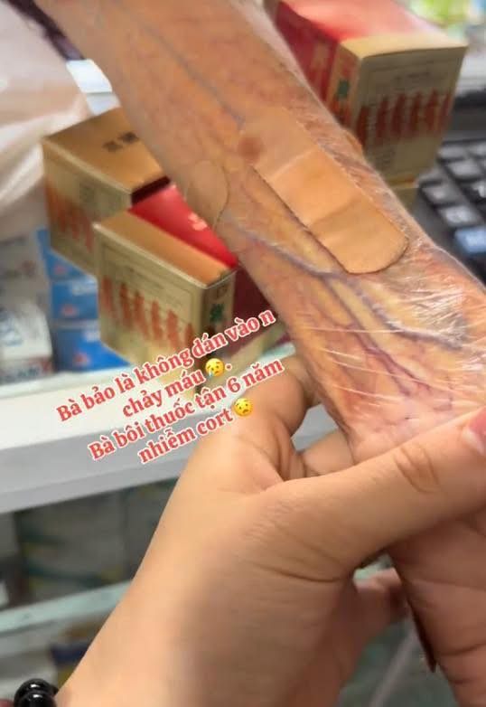 Choáng với cánh tay của cụ bà lạm dụng corticoid, da 